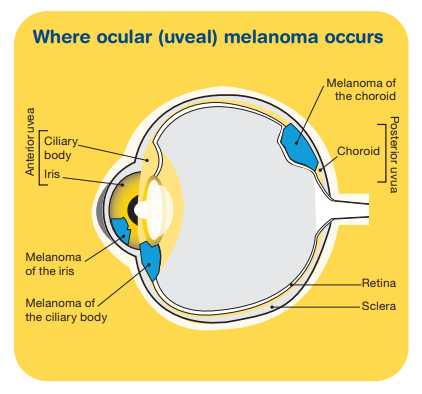 A cartoon showing the various parts of the eyes where ocular melanoma develops.